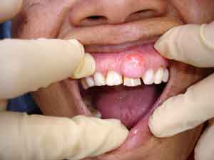 dental  abscess