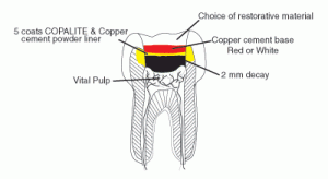 pulp-capping-method