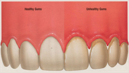Pictures+of+healthy+gums+and+teeth