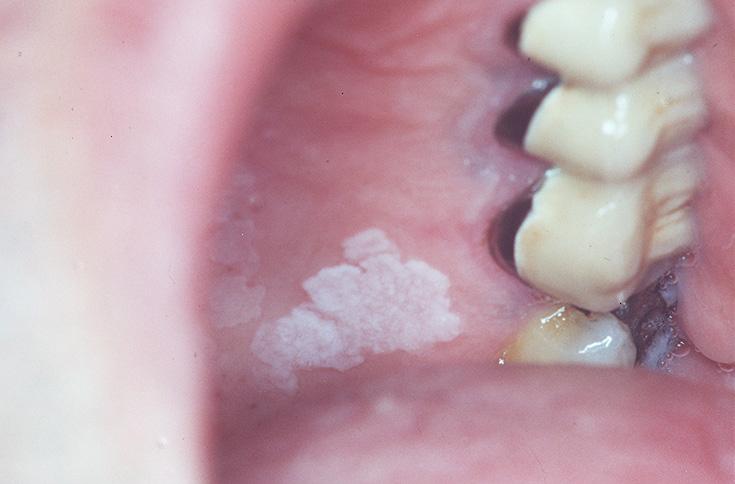 Oral Leukoplakia Pictures Photos