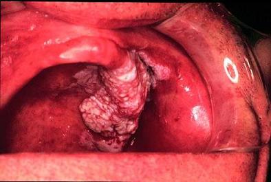 Oral cancer