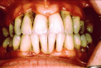 Periodontitis Chetan