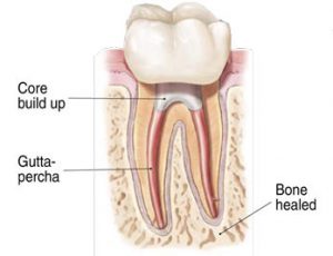 Root Canal Treatment