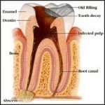 Abscessed Tooth - Causes, Symptoms & Treatments