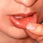 Canker Sores - Causes, Symptoms & Treatments