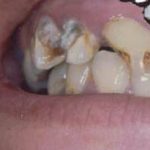 Meth Mouth - Causes, Symptoms & Treatments