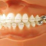 Orthodontics - Treatment Of Malocclusion