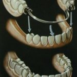 Partial Dentures Types Cost Problems