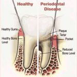 Periodontal (Gum) Disease - Causes, Symptoms & Treatments