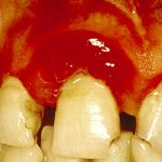 bleeding gums diabetes