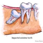 impacted wisdom tooth