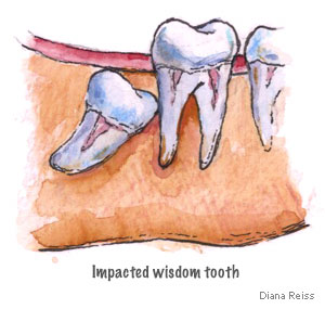 impacted wisdom tooth