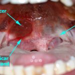 oral submucous fibrosis