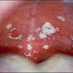 oral thrush candida