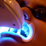 teeth whitening