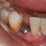 dental implant