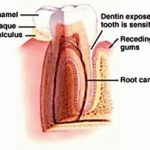 dentin tooth sensitivity