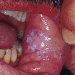 oral thrush