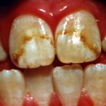 dental fluorosis