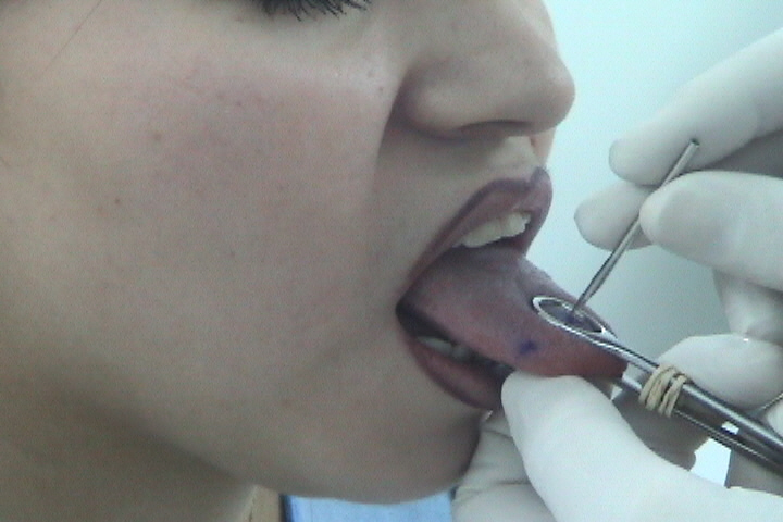 tongue piercing operation