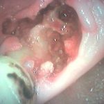 tooth extraction socket