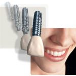 dental implants advantages