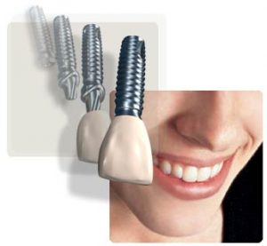 dental implants advantages