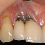 Dental implant problem