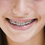 Dental Braces