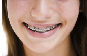 Dental Braces