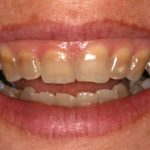 Tetracycline tooth stains