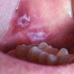 Leukoplakia