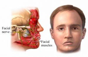 Facial Nerve