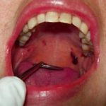 Hematoma Palate