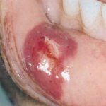 Hematoma lower lip