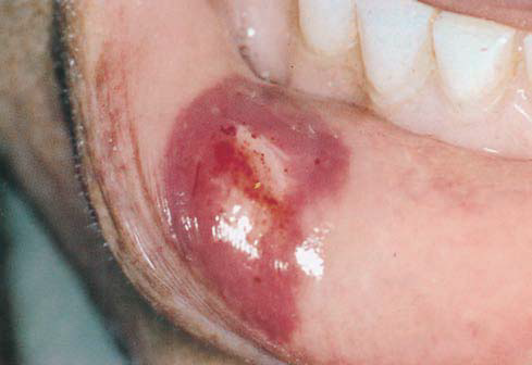Hematoma lower lip