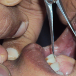 Oral submucous Fibrosis interincisal distance