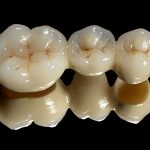 Dental Crown