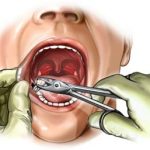 Tooth Extraction Cost