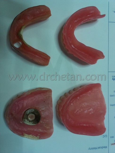 Normal Denture and Watcher 2