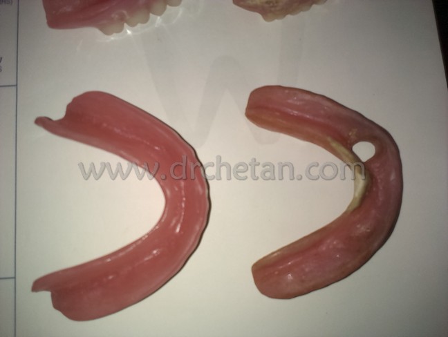 Normal Denture and Watcher 3