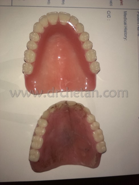 Normal Denture and Watcher 5