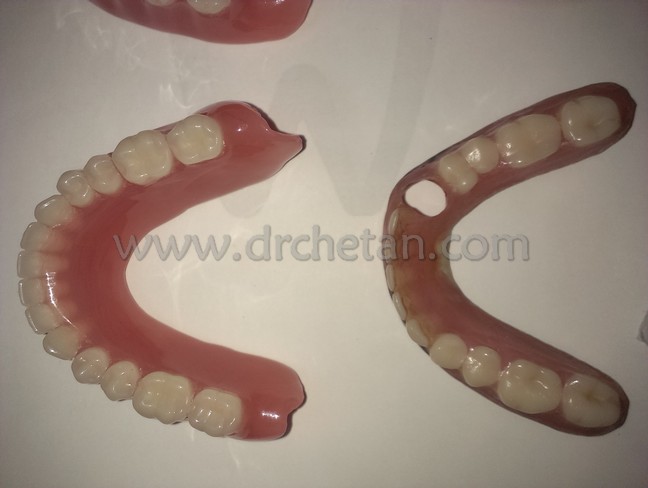 Normal Denture and Watcher 6