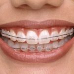 Ceramic braces