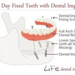 implant denture