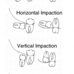Impactions based on Angle