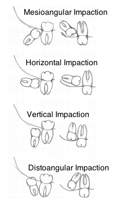 Impactions based on Angle