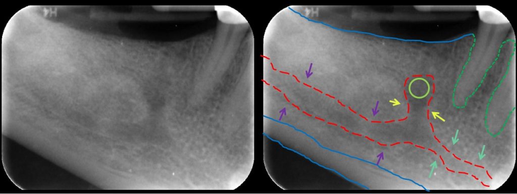 clinical mandibular canal