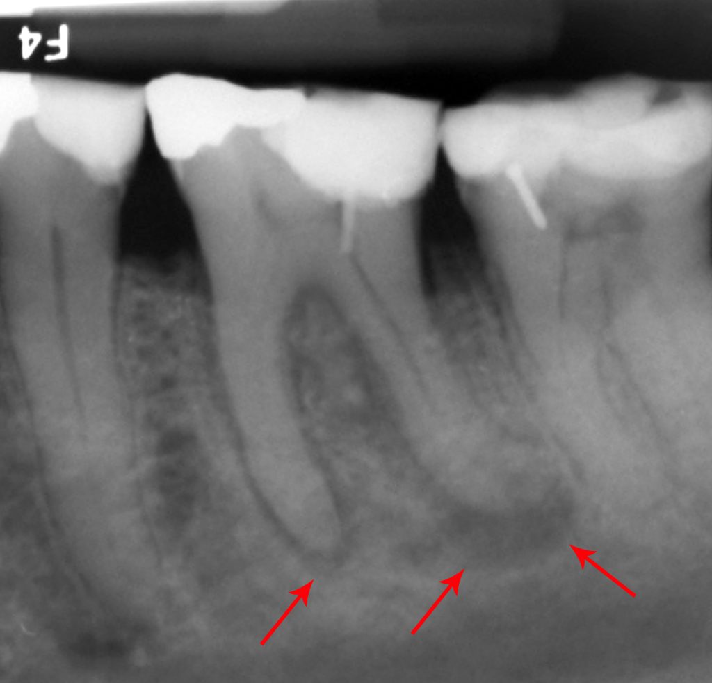 clinical molar periapical radiolucencies